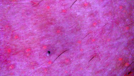 Caso de tricoscopia para identificar