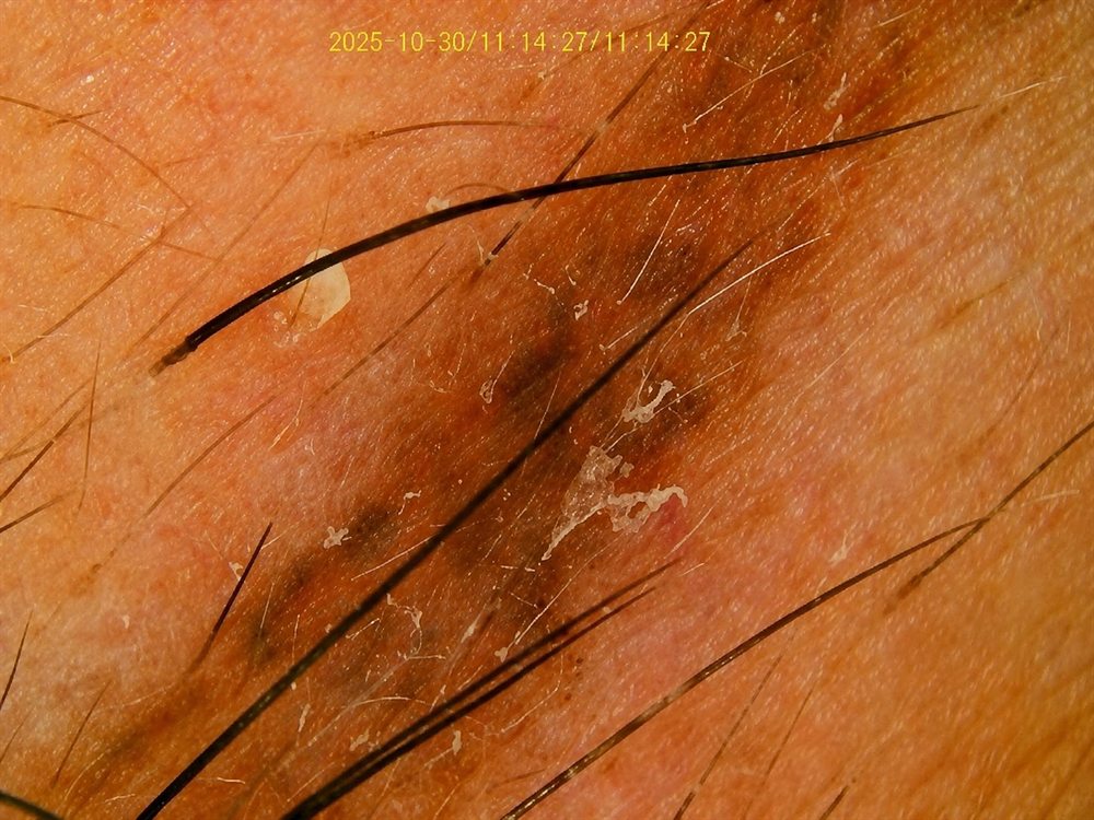 Caso de tricoscopia para identificar